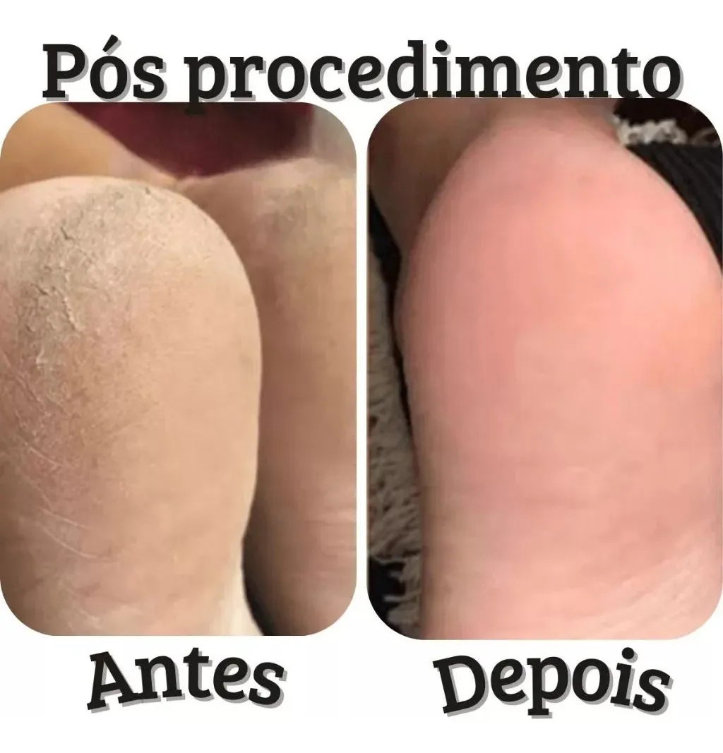 AMACIANTE AMOLECEDOR DE CUTÍCULAS E CALOSIDADES REPÓS 1,1 LT - Imagem 3